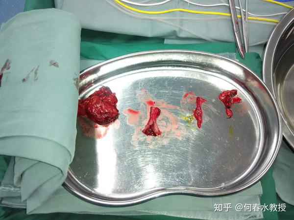 呈非凹陷性,张力较高,皮肤无发红,皮温高,右下肢腓肠肌压痛,homan'