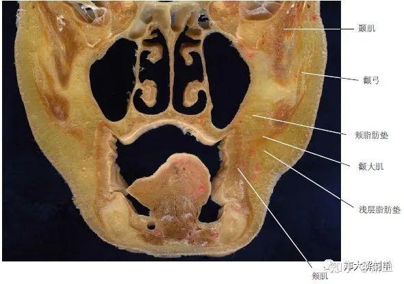 头部冠状面显示的颊脂肪垫
