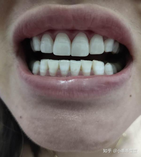 这个是刚刚做好的样子,我的牙龈那里就是那样的,所以两颗门牙上边不一