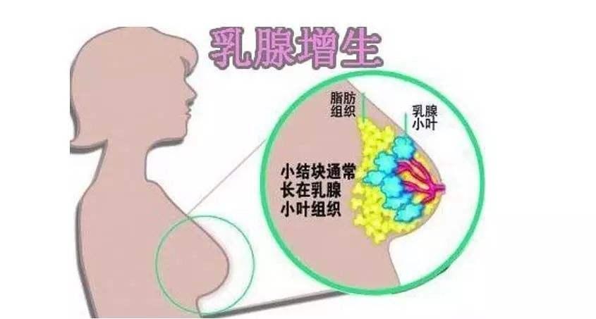 女性乳腺增生是怎么回事该如何防止你都了解吗