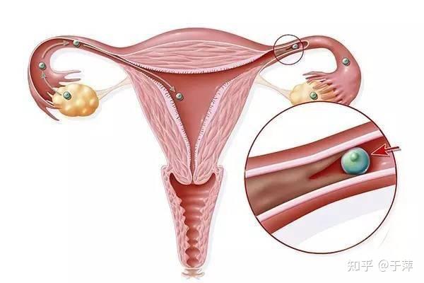 于萍讲孕育关于输卵管试管婴儿多囊卵巢功能的四个典型问题解答