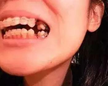 为什么矫正牙齿需要拔牙?