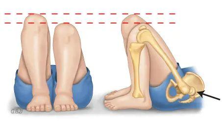 孩子大腿皮纹臀纹不对称可能影响走路快观察
