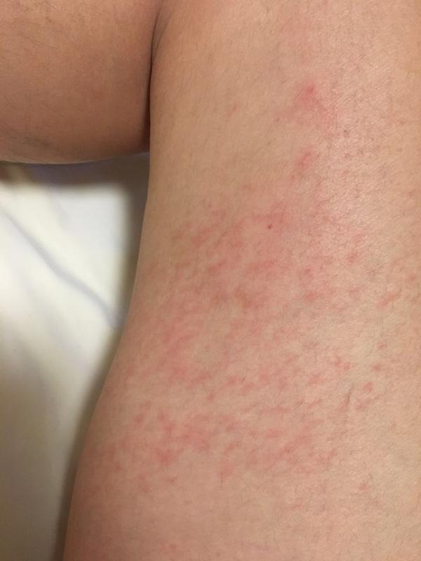 一到冬天大腿上就长了很多红红的点,又是奇痒无比.这是什么皮肤病?