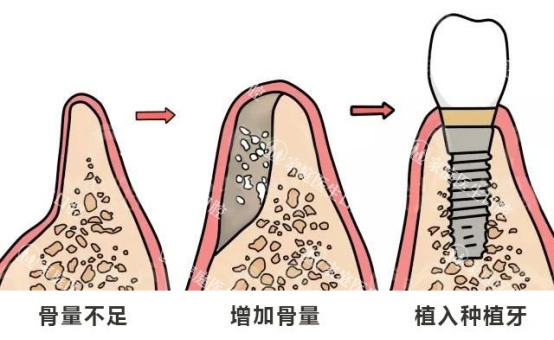 牙槽骨萎缩还能种牙嘛