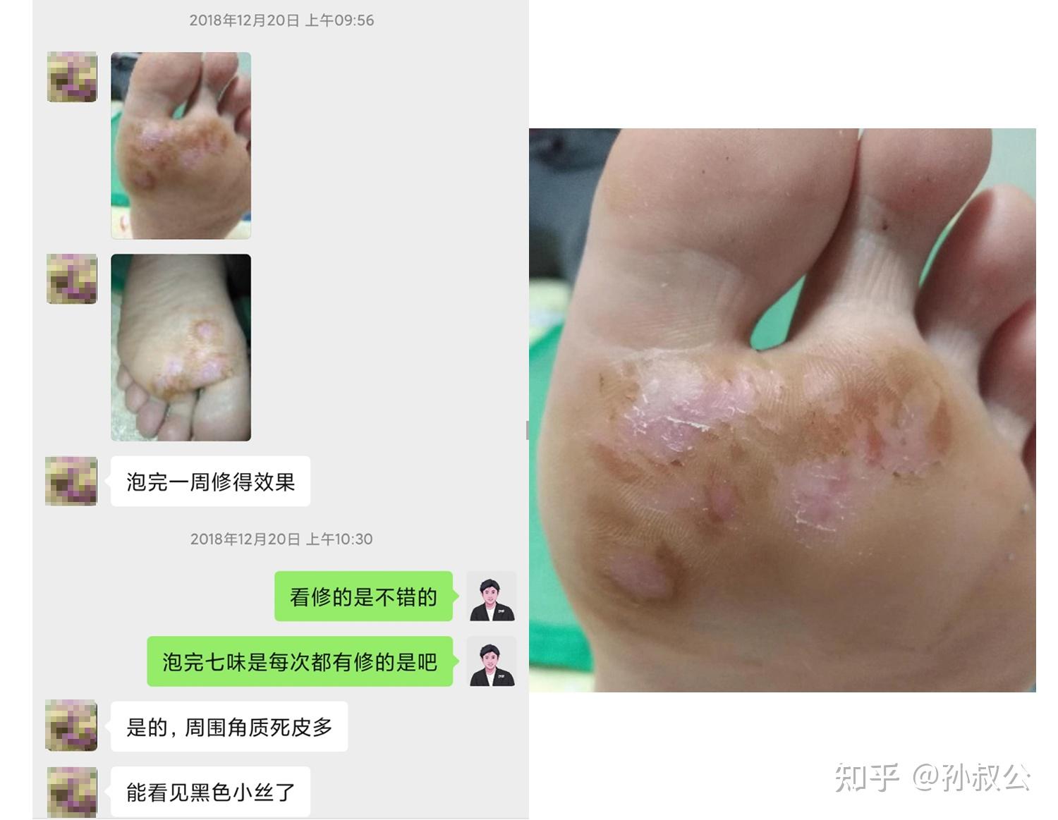 老查」首次咨询:感染4个月,被刺扎后处理不当感染了手疣,期间用指甲剪