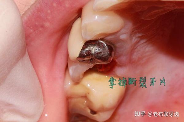 所以医生通常会建议做完根管治疗的牙齿做牙套保护起来