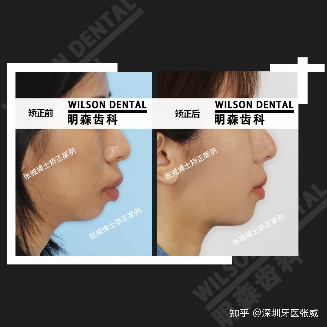我感觉自己凸嘴人中长和下巴短附上自己笑和没笑的对比照请问我这是
