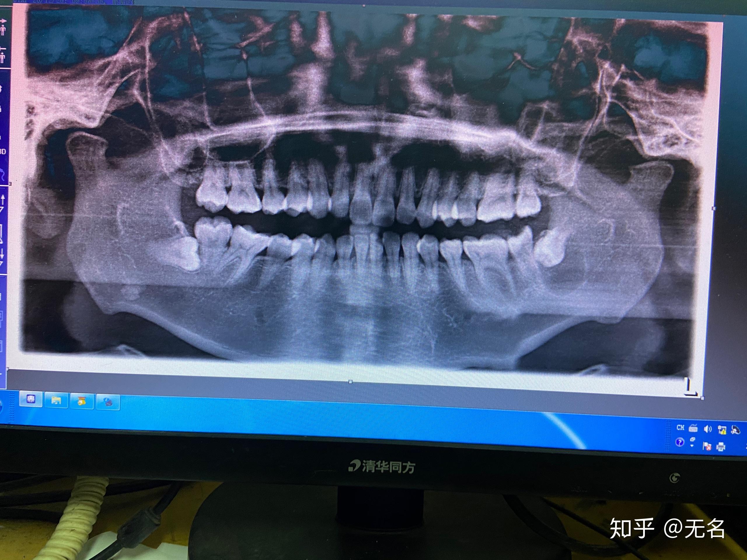 含牙囊肿日记1