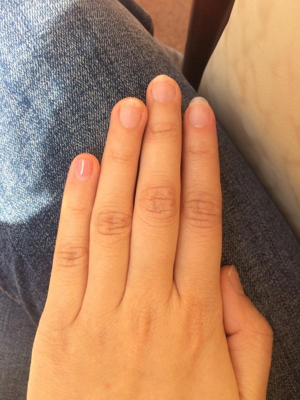 手指甲被咬的超级短怎么办?