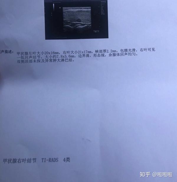 甲状腺乳头癌三家b超报告
