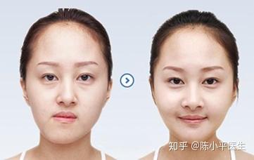 改脸型手术可以做单侧吗?