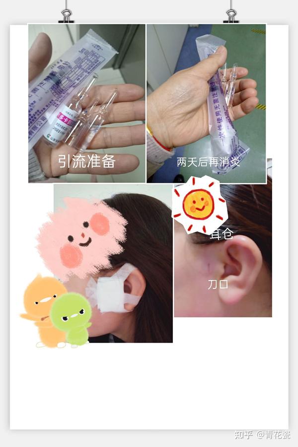 耳前瘘管发炎引流切除