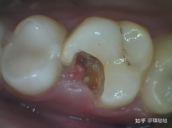 根管治疗亲身经历分享