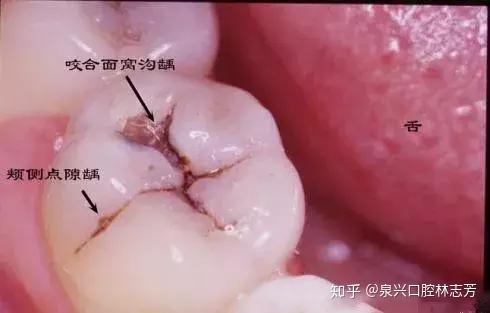 后牙上的黑线是蛀牙吗?该如何预防?