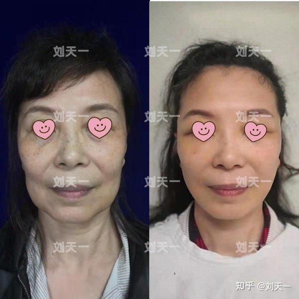 拉皮手术第一次不满意可以做修复吗?(5)术后十天效果如何?
