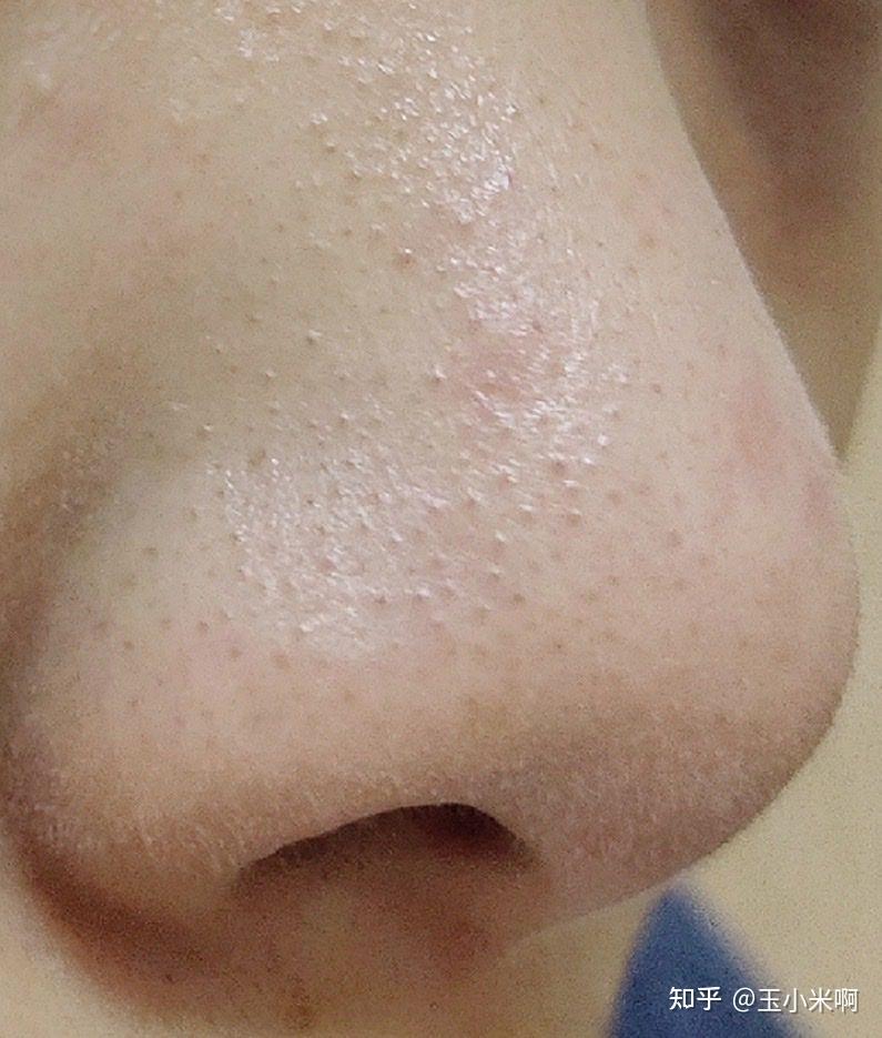我有一个很严重的草莓鼻,有时候看到满鼻子的黑头,觉得自己的鼻子很丑