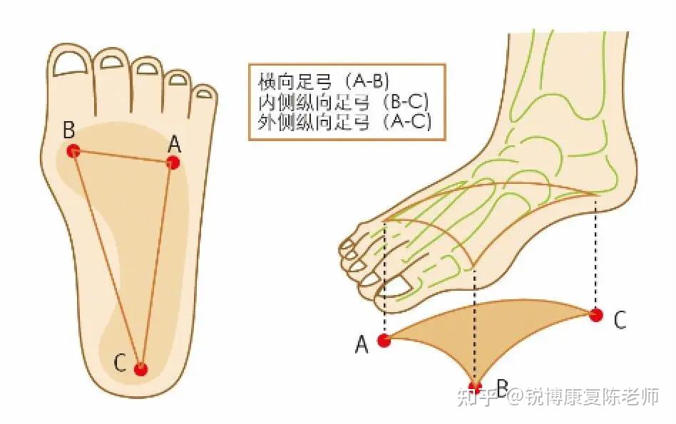 锐博康复扁平足or足弓塌陷脚平的你还有没有救