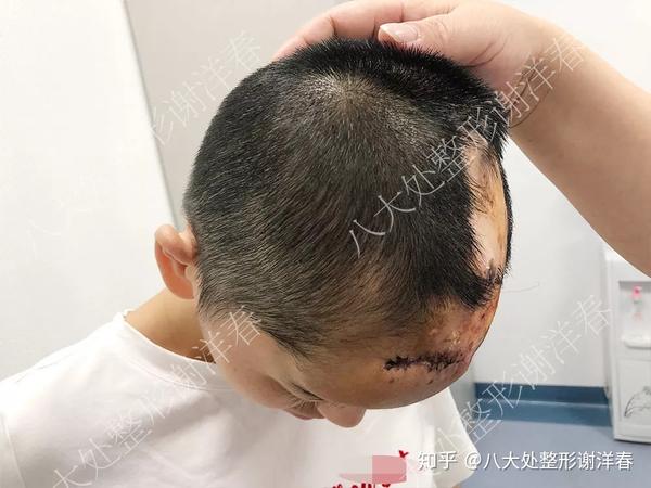 经典案例分享扩张器是如何解决头皮大面积疤痕的