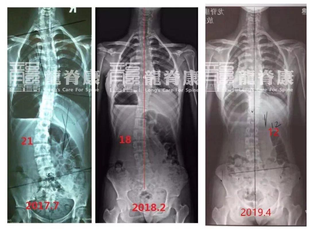 15岁脊柱侧弯女孩从21减至12终于不用戴支具啦