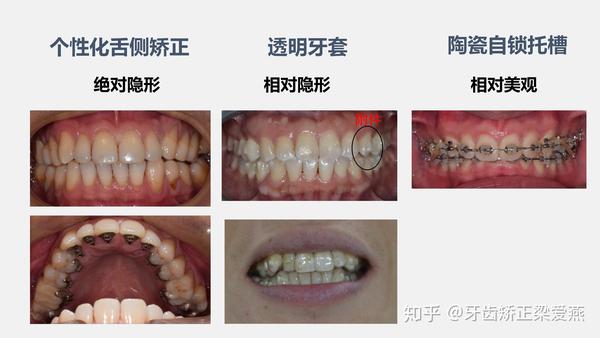 隐形矫正之—舌侧矫正与透明牙套的异同点