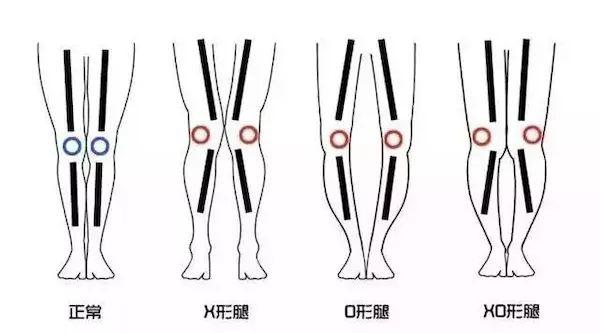 我想知道我这腿是xo腿么?