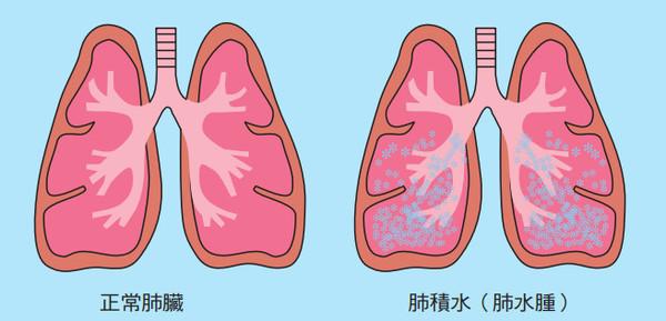 唐跃良 肺积水好治疗吗?饮食上注意什么?