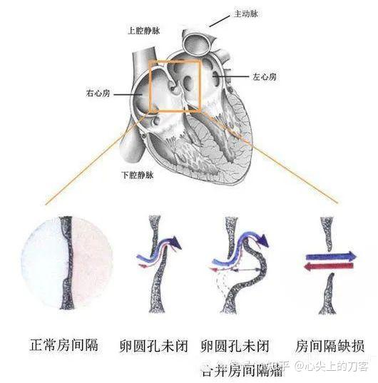 如果发现了自己的心脏比别人多了一个洞——卵圆孔未闭,如果没有什么