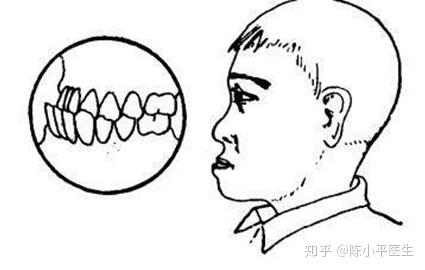 反颌矫正术-修正土气地包天