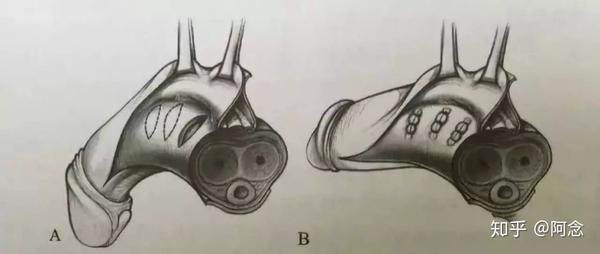 阴茎硬结症 知乎