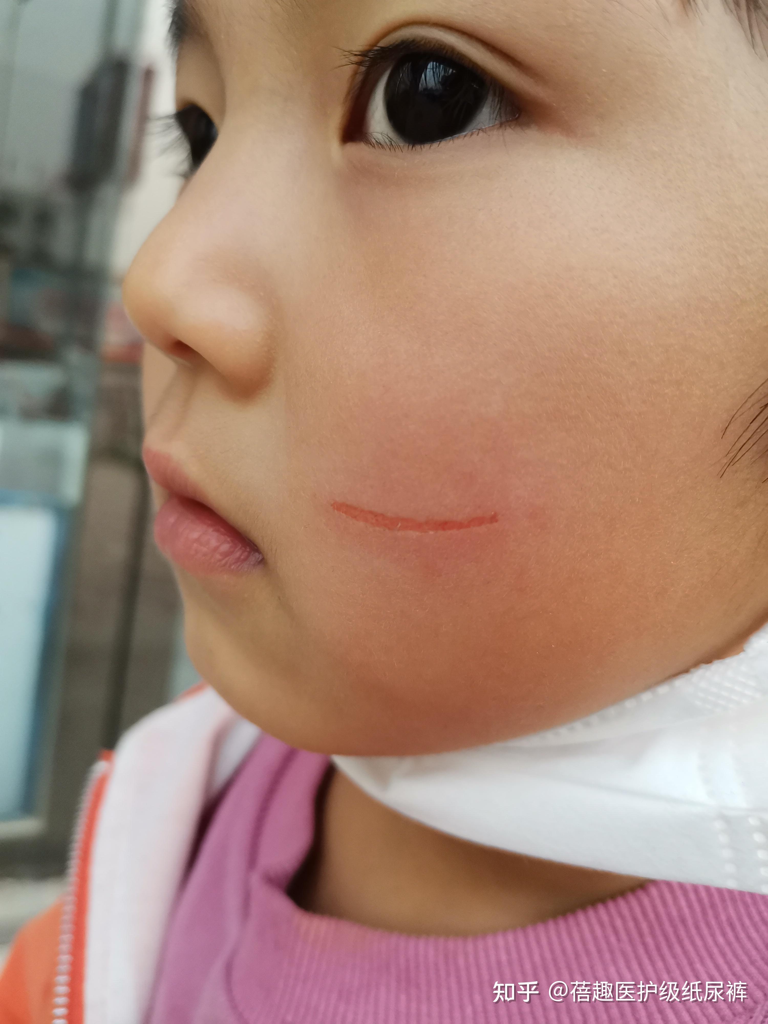 孩子在幼儿园被抓伤已形成永久疤痕现在和幼儿园商议赔偿事宜大家觉得