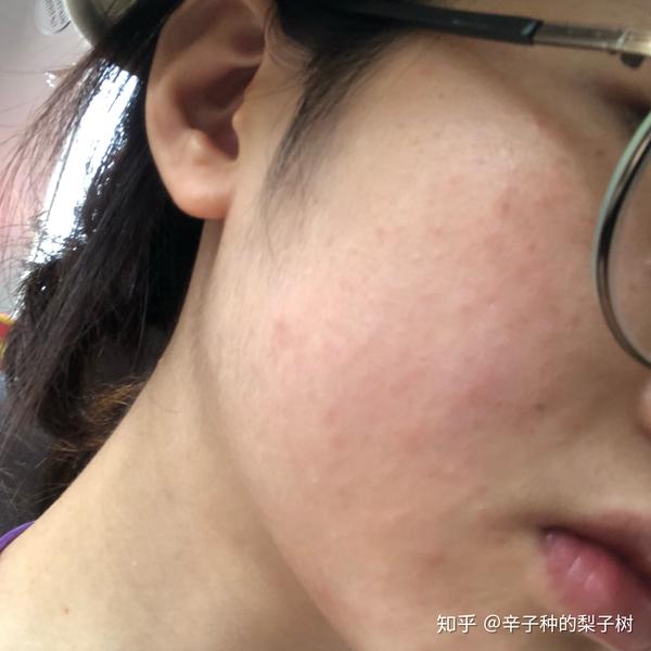 脸上长了很多又红又痒逆光疹子有些透明的尖头看起来油油的脂溢性皮炎