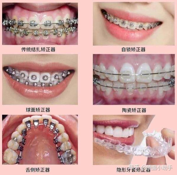 成年人牙齿矫正与青少年有什么区别?