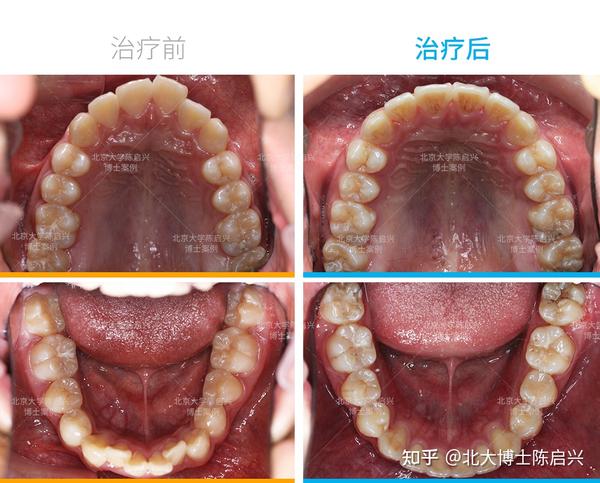 腺样体面容兔牙深覆盖矫正案例