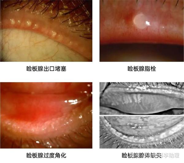 位于睑缘的一排睑板腺开口堵塞,经常见到堵塞在开口处的淡黄色半透明