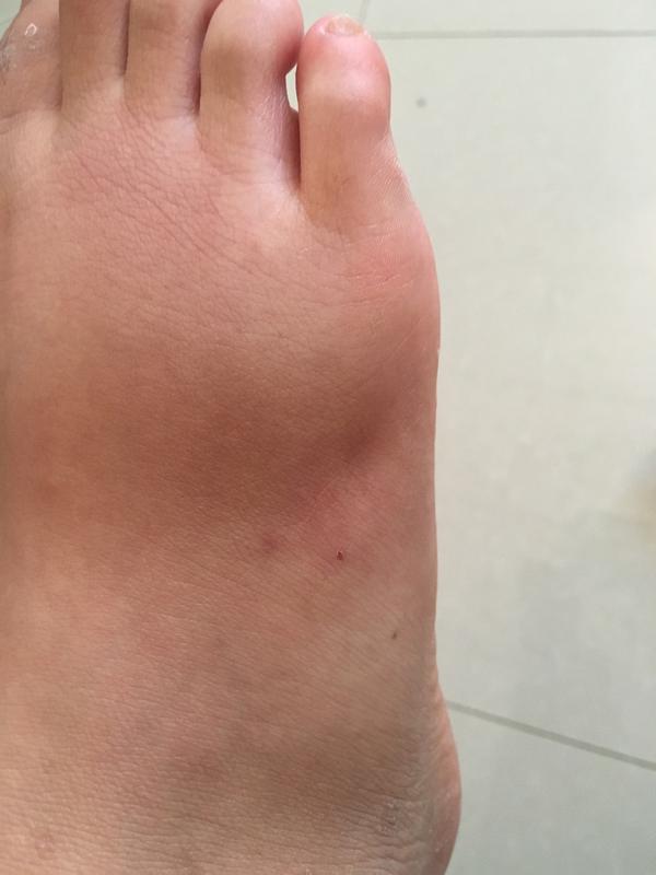 这是我被蜘蛛咬过的脚,已经快好了,但是肿得一恩还是一个坑.