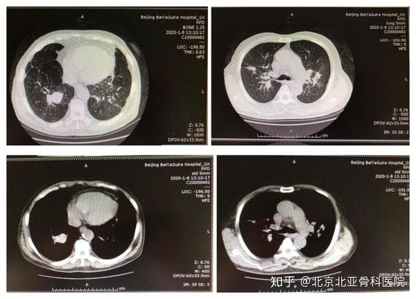 尘肺小科普 1,什么是尘肺?