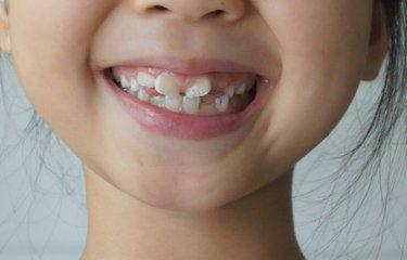 正常牙齿形态都是整齐而洁白的,但有些人牙齿却是是东倒西歪的,甚至