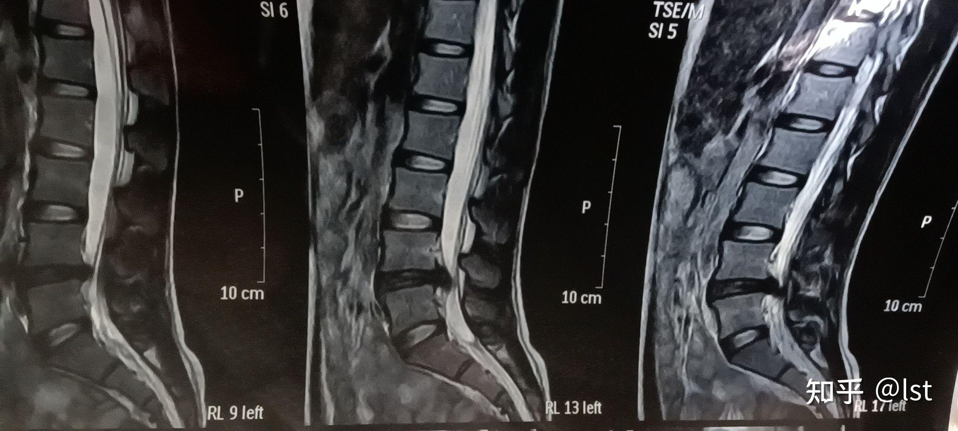 31岁今天做了ct结果显示腰椎间盘突出已经哭了一下午了好害怕知乎大大