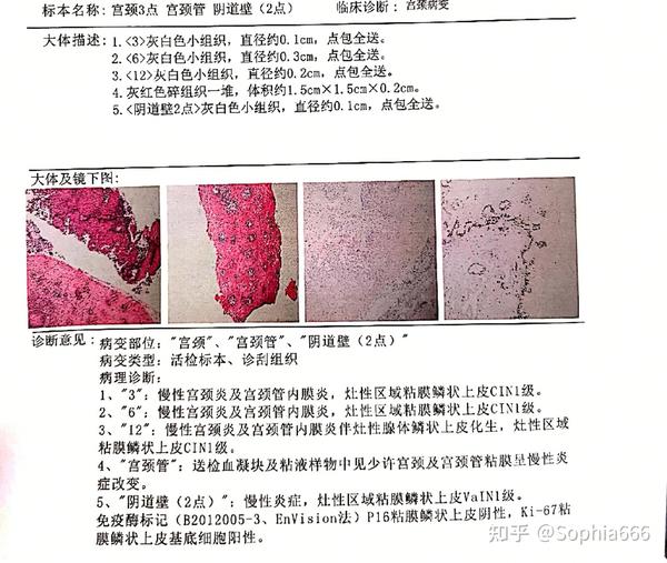 宫颈活检病理分析