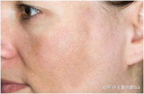 色素沉着 形成原因:由于内分泌失调,面部出现色斑,暗疮等肌肤问题