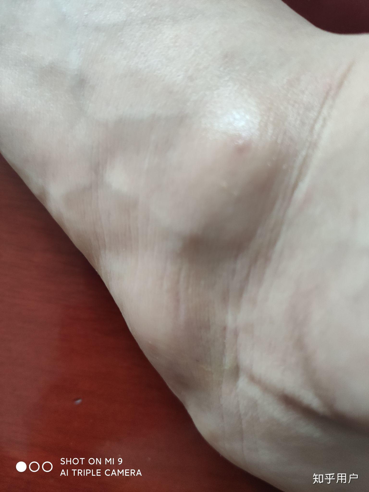 被蚂蚁咬了伤口周围有硬物感中间还有个小泡今天是第三天了还没好怎么