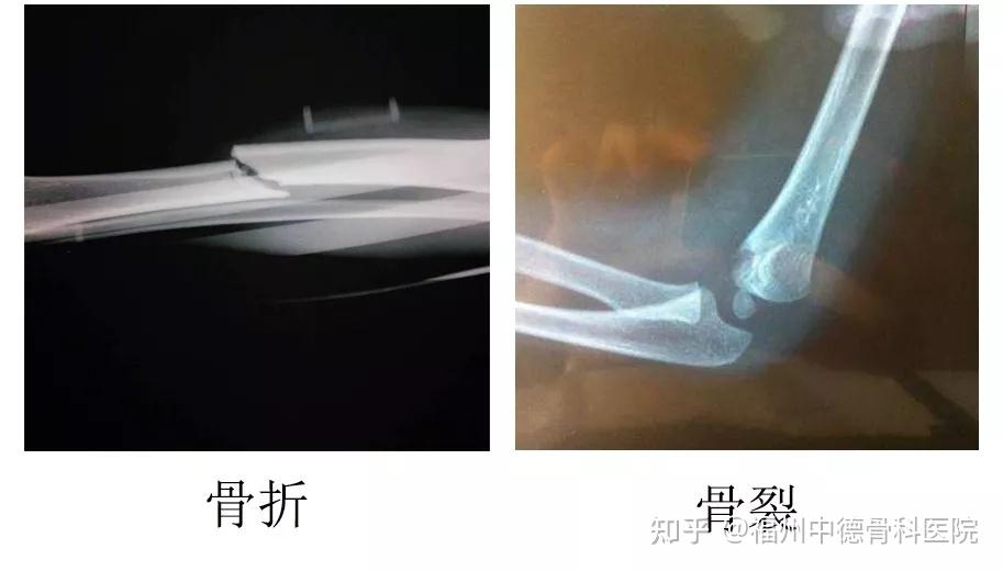 一文读懂│骨裂真的跟骨折不一样么