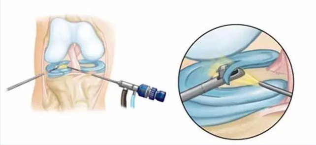 二度半月板损伤三度半月板损伤该如何治疗