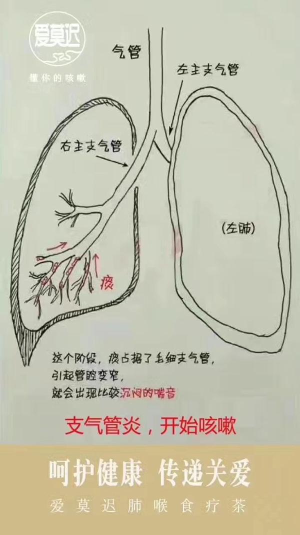 干咳~有痰~咳喘~减轻~康复 痰所在的位置不一样 表现的症状也就不一样