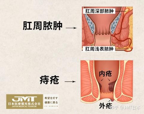 jmt日本医疗痔疮肛周脓肿是否有发展成直肠癌的风险