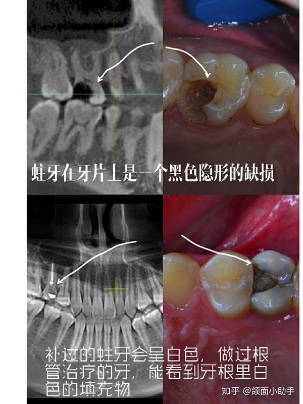 蛀牙通常可以通过牙片发现,尤其是龋坏比较多的,在牙片上会出现黑色