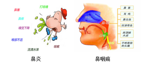 怎么判断自己得了鼻炎还是鼻咽癌?