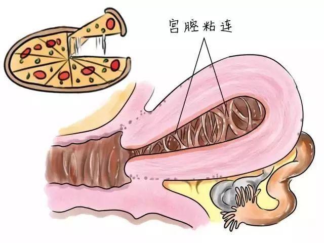 宫腔粘连?这些问题你必须知道