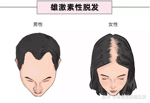 雄性激素性脱发,简称雄脱,从名字已经可以得知,这种类型的脱发与人体